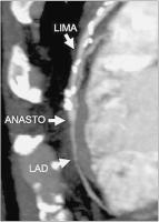 Abbildung 2b: Bypässe - MPR - MIP