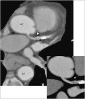 Abbildung 4b: Rezidivstenose