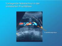 Abbildung 1: Vorliegende Nabelschnur