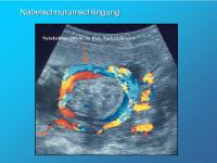 Abbildung 3: Nabelschnurumschlingung