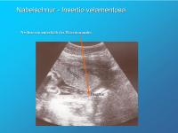 Abbildung 5: Nabelschnur - Insertion velamentosa