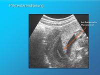Abbildung 6: Plazentarandlösung