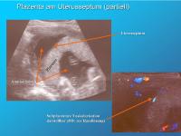 Abbildung 8: Plazenta am Uterusseptum (partiell)