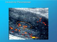 Abbildung 10: Intrauterine Plazentareste