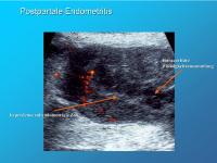 Abbildung 11: Postpartale Endometritis
