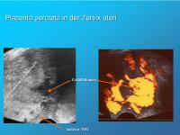 Abbildung 12: Plazenta percreta - Zervix uteri