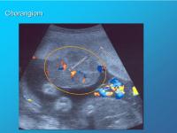 Abbildung 13: Chorangiom