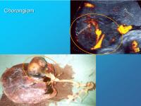 Abbildung 14: Chorangiom