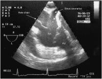 Abbildung 2: Rete chiari