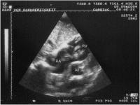 Abbildung 4: Flottierender Thrombus