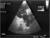 Abbildung 5: Kugelthrombus