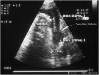 Abbildung 6-a: Flottierender Thrombus
