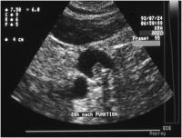 Abbildung 7: Katheterassoziierte Thrombose