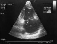 Abbildung 9: Endokarditis - Valv. tricuspidalis
