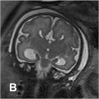 Abbildung 2-b: Pränatale Magnetresonanztomographie