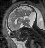 Abbildung 3: Pränatale Magnetresonanztomographie