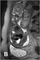 Abbildung 6-b: Pränatale Magnetresonanztomographie
