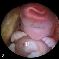Abbildung 6-a: Triploider Embryo