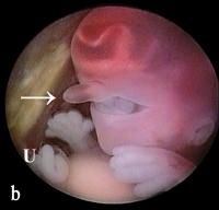 Abbildung 6-b: Triploider Embryo