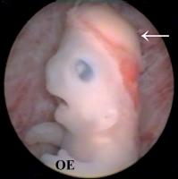 Abbildung 9: Embryo - Scheitel-Steißlage