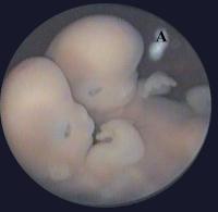 Abbildung 11: Thorakopagus