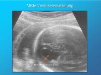 Abbildung 4: Milde Ventrikelerweiterung