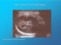 Abbildung 5: Asymmetrische Ventrikulomegalie