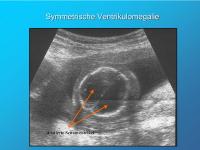 Abbildung 6: Symmetrische Ventrikulomegalie