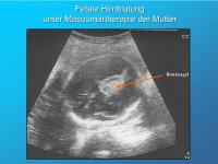Abbildung 7: Fetale Hirnblutung unter Macoumartherapie der Mutter