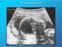 Abbildung 8: Holoprosencephalie