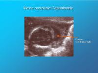 Abbildung 9: Kleine occipitale Cephalocele