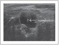 Abbildung 9: Zyste - Ultraschallgezielte Feinnadelpunktion