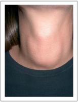 Abbildung 1: Struma diffusa