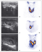 Abbildung 4a-f: Knotenstruma