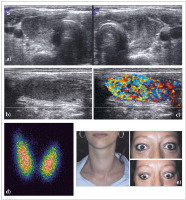Abbildung 7: Morbus Basedow