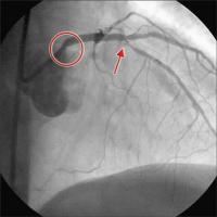 Linke Koronararterie RAO/Kranialprojektion