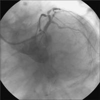 Abbildung 2: Linke Koronararterie LAO/Kaudalprojektion