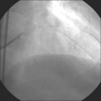 Abbildung 3: Sondierung - BMW-Führungsdraht