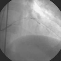 Abbildung 4: Vordilatation LAD