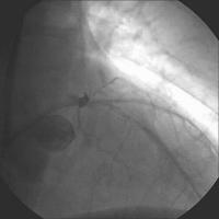 Abbildung 5: Vordilatation - Ergebnis