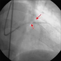 Abbildung 6: Stentimplantation - LAD