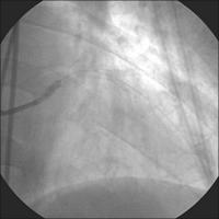 Abbildung 11: Primäre Stentimplantation - Ostiumhauptstamm