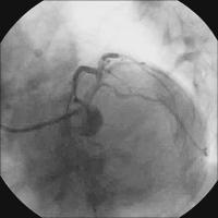 Abbildung 13: Endergebnis LAO/kaudal
