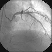 Abbildung 14: Kontrollangiographie