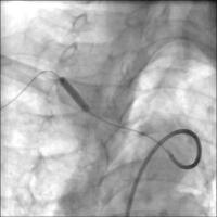 Abbildung 3: Vordilatation