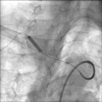 Abbildung 4: Stentposition