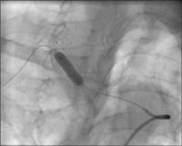 Abbildung 5: Postdilatation