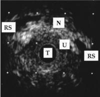 Abbildung 1: Transurethrale Sonographie