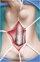 Abbildung 1: Kollagenimplantat - Bulbäre Harnröhre