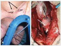 Abbildung 2a-b: AMS-Sphinkterprothese - Operation